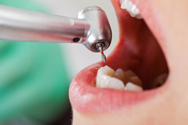Best Emergency Root Canal Treatment in Parsons, WV